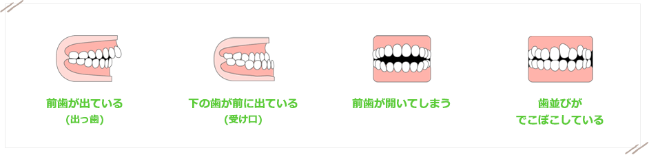 お子様の正しい成長を妨げる不正咬合