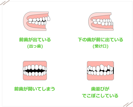 お子様の正しい成長を妨げる不正咬合